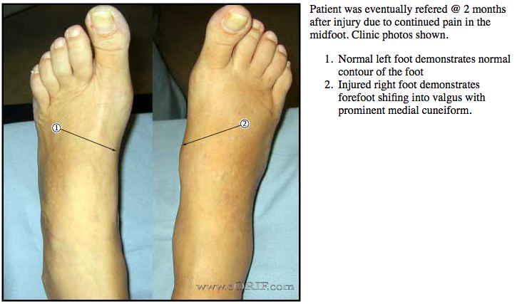 lisfranc-fracture-dislocation-s93-326a-838-03-eorif